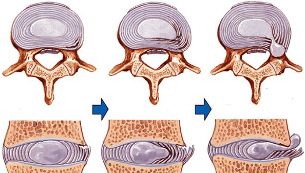uraz kręgosłupa w osteochondrozie