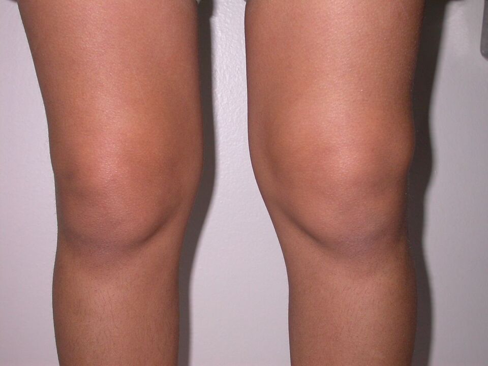 obrzęk kolana z powodu choroby zwyrodnieniowej stawów