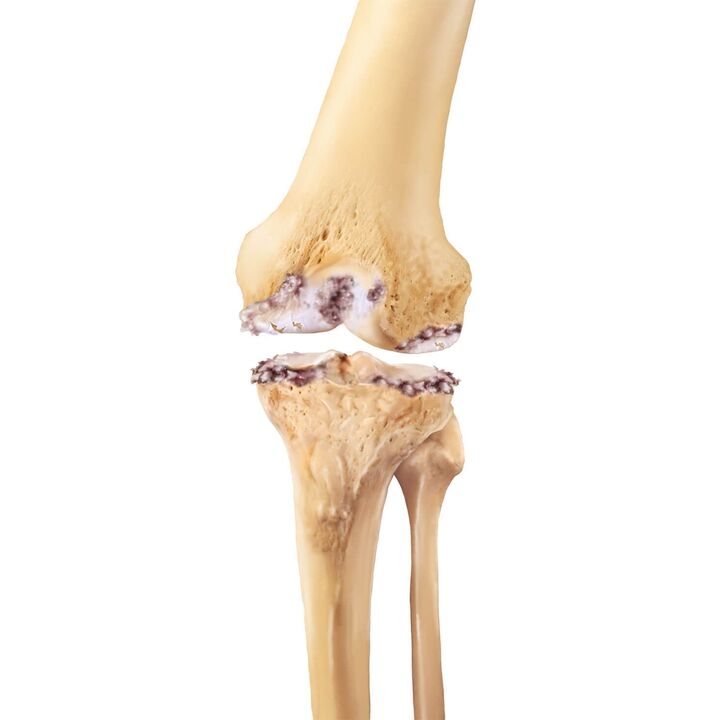 zniszczenie stawu kolanowego z artrozą
