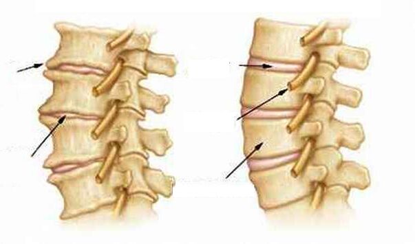 Co to jest osteochondroza