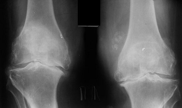 X -ray jako sposób zdiagnozowania artrozy stawu kolanowego