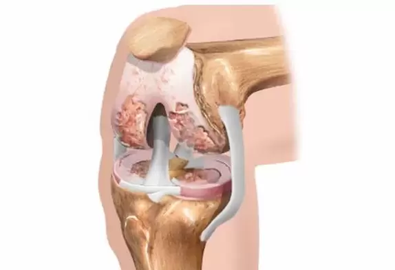 artroza kolana