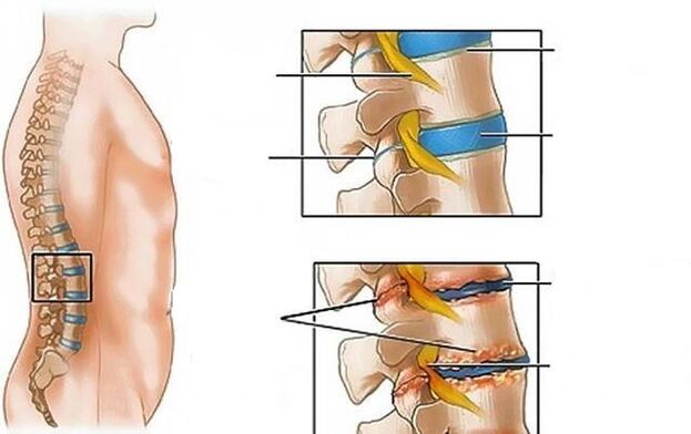 osteochondroza kręgosłupa lędźwiowego powoduje ból pleców back